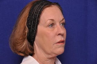 Renuva Before & After Gallery - Patient 112689 - Image 6