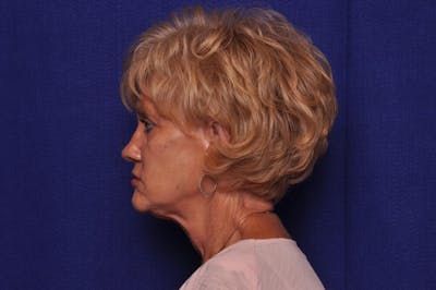 Renuva Before & After Gallery - Patient 244679 - Image 1