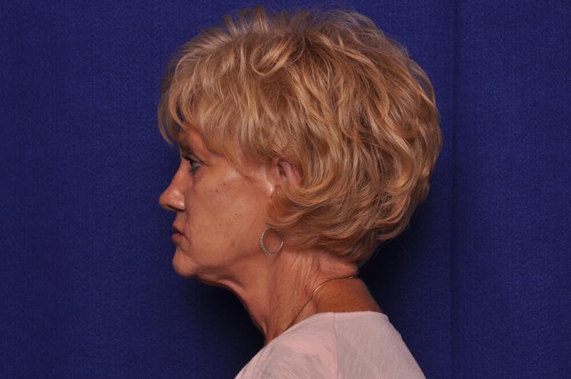 Renuva Before & After Gallery - Patient 244679 - Image 1