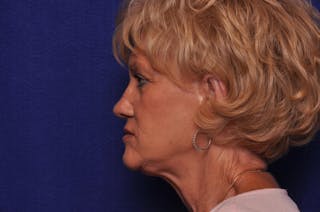 Renuva Before & After Gallery - Patient 244679 - Image 2