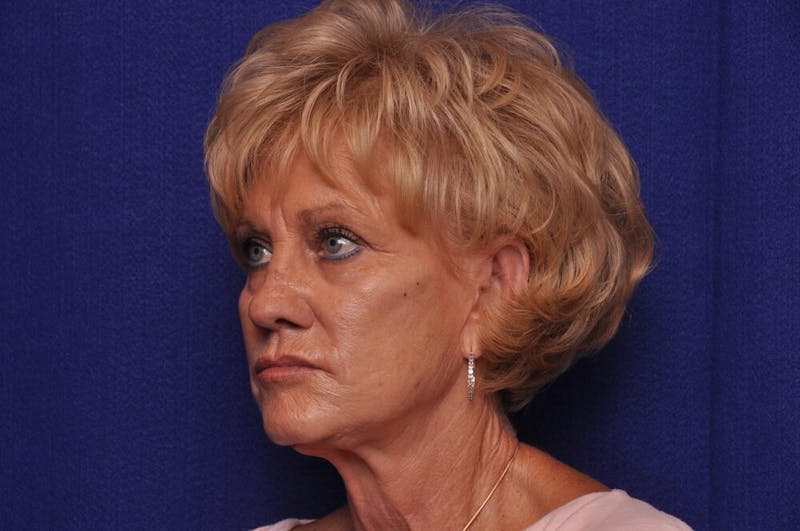 Renuva Before & After Gallery - Patient 244679 - Image 3
