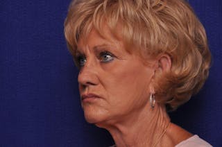 Renuva Before & After Gallery - Patient 244679 - Image 4