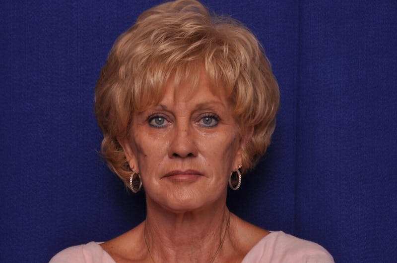 Renuva Before & After Gallery - Patient 244679 - Image 5