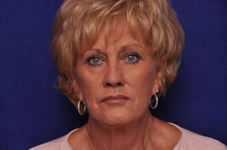 Renuva Before & After Gallery - Patient 244679 - Image 6