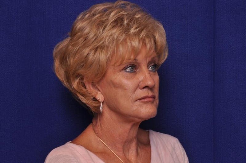 Renuva Before & After Gallery - Patient 244679 - Image 7