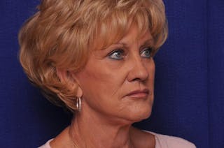 Renuva Before & After Gallery - Patient 244679 - Image 8