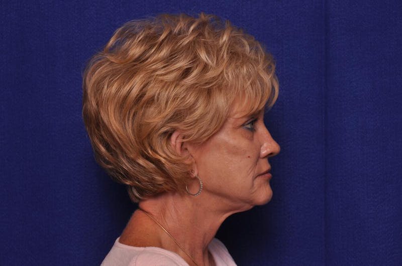 Renuva Before & After Gallery - Patient 244679 - Image 9