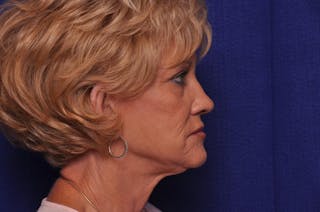 Renuva Before & After Gallery - Patient 244679 - Image 10