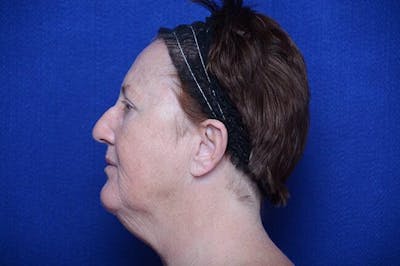 Rhinoplasty Before & After Gallery - Patient 388760 - Image 1