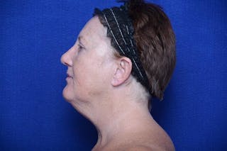 Rhinoplasty Before & After Gallery - Patient 388760 - Image 2