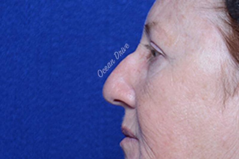 Rhinoplasty Before & After Gallery - Patient 388760 - Image 3