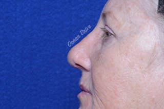 Rhinoplasty Before & After Gallery - Patient 388760 - Image 4