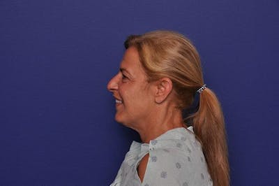 Rhinoplasty Before & After Gallery - Patient 102930 - Image 1