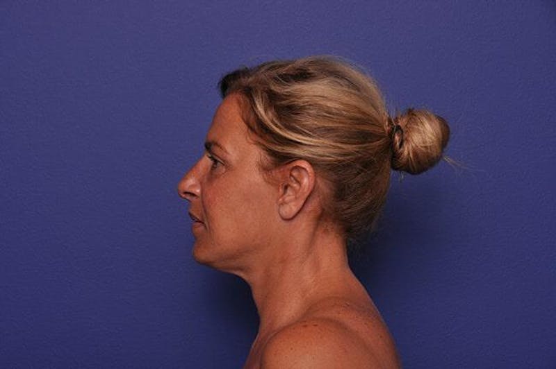 Rhinoplasty Before & After Gallery - Patient 102930 - Image 2