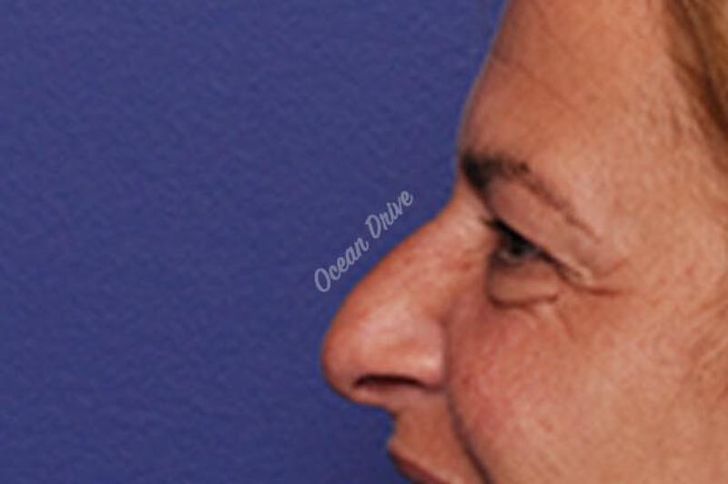 Rhinoplasty Before & After Gallery - Patient 102930 - Image 3