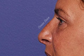 Rhinoplasty Before & After Gallery - Patient 102930 - Image 4