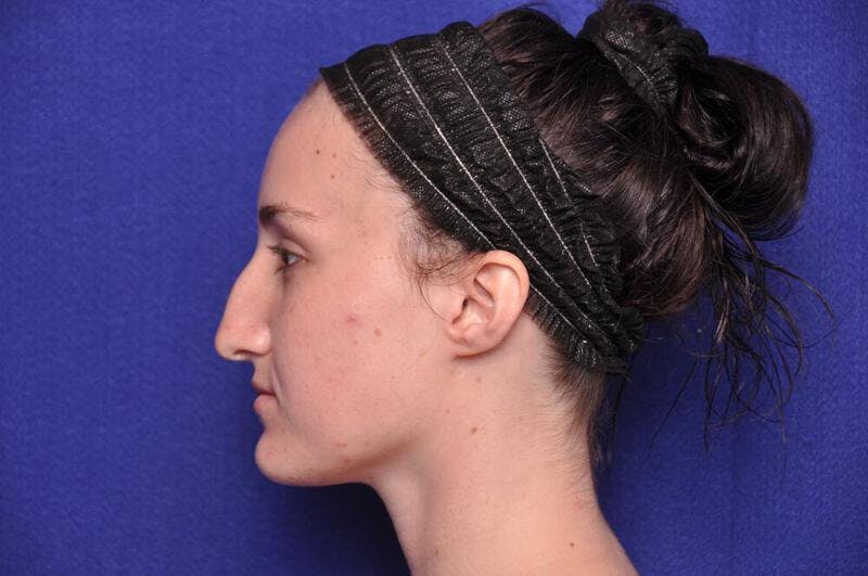 Rhinoplasty Before & After Gallery - Patient 270274 - Image 1