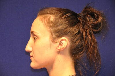 Rhinoplasty Before & After Gallery - Patient 270274 - Image 2