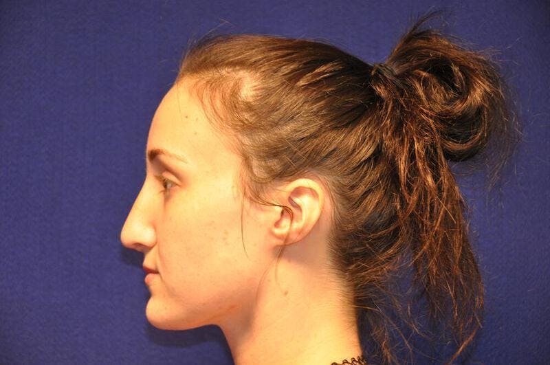 Rhinoplasty Before & After Gallery - Patient 270274 - Image 2