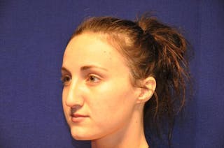 Rhinoplasty Before & After Gallery - Patient 270274 - Image 4