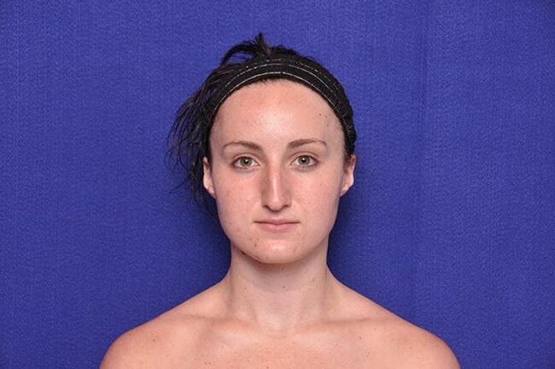 Rhinoplasty Before & After Gallery - Patient 270274 - Image 5