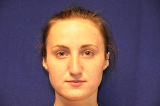 Rhinoplasty Before & After Gallery - Patient 270274 - Image 6