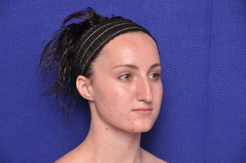 Rhinoplasty Before & After Gallery - Patient 270274 - Image 7