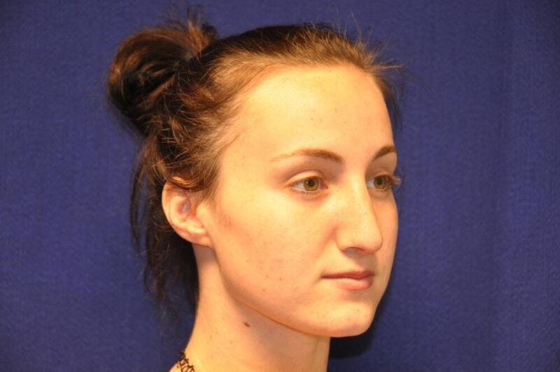 Rhinoplasty Before & After Gallery - Patient 270274 - Image 8