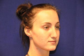Rhinoplasty Before & After Gallery - Patient 270274 - Image 8