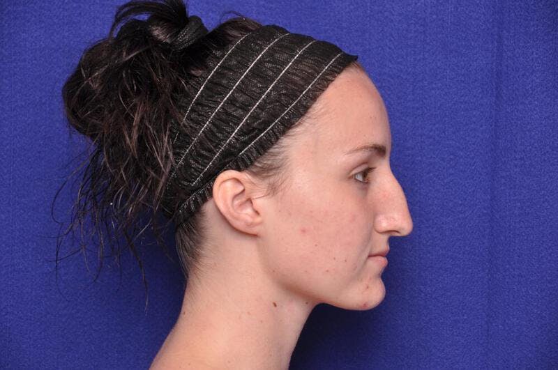 Rhinoplasty Before & After Gallery - Patient 270274 - Image 9