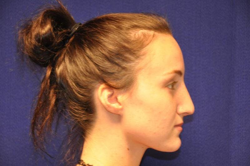 Rhinoplasty Before & After Gallery - Patient 270274 - Image 10