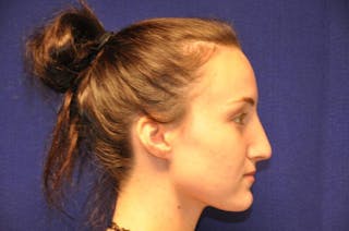 Rhinoplasty Before & After Gallery - Patient 270274 - Image 10