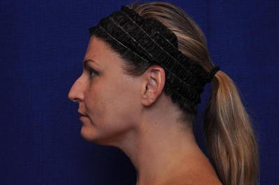 Rhinoplasty Before & After Gallery - Patient 202511 - Image 1