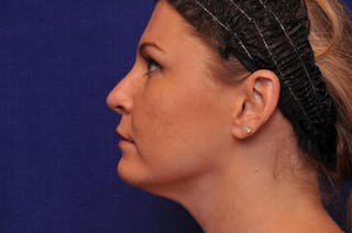 Rhinoplasty Before & After Gallery - Patient 202511 - Image 2