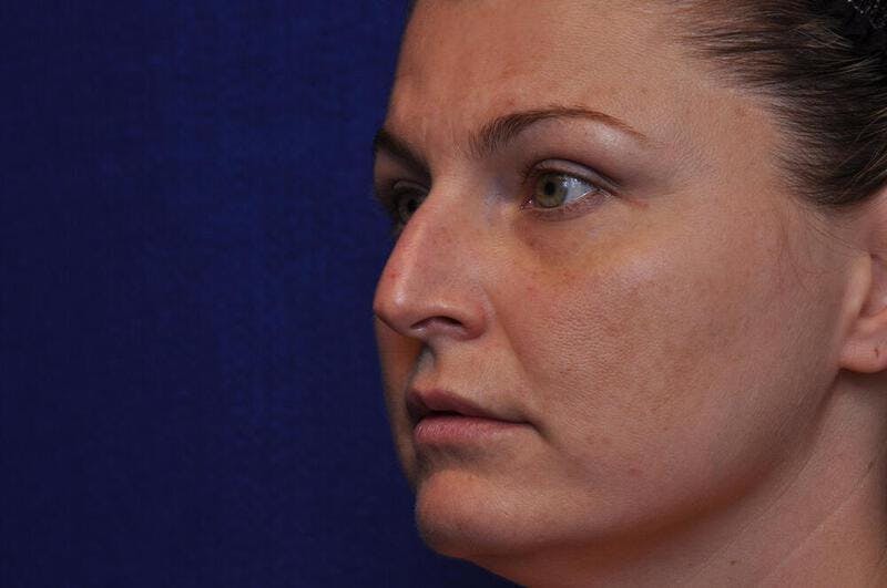 Rhinoplasty Before & After Gallery - Patient 202511 - Image 3