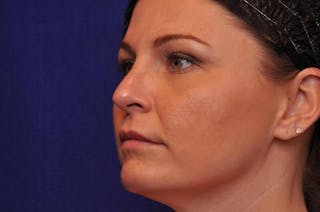 Rhinoplasty Before & After Gallery - Patient 202511 - Image 4
