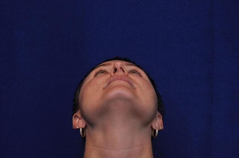 Rhinoplasty Before & After Gallery - Patient 202511 - Image 5