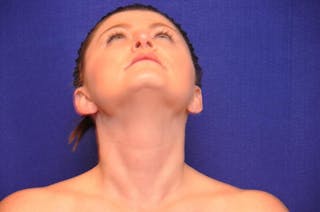 Rhinoplasty Before & After Gallery - Patient 202511 - Image 6