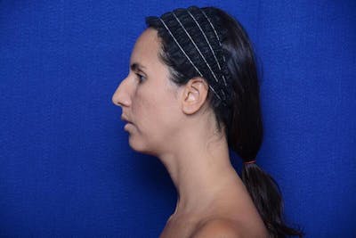 Rhinoplasty Before & After Gallery - Patient 174888 - Image 1