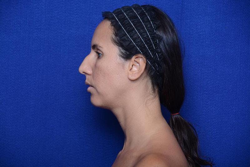 Rhinoplasty Before & After Gallery - Patient 174888 - Image 1