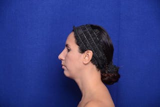 Rhinoplasty Before & After Gallery - Patient 174888 - Image 2