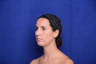 Rhinoplasty Before & After Gallery - Patient 174888 - Image 4