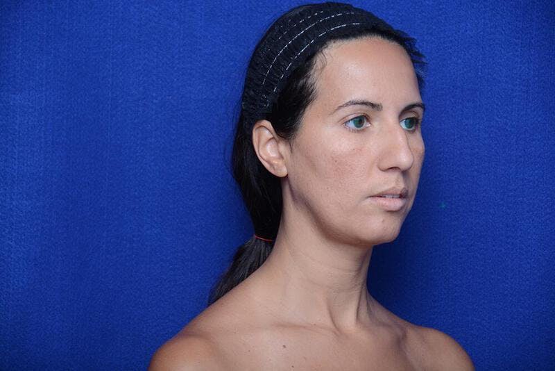 Rhinoplasty Before & After Gallery - Patient 174888 - Image 5