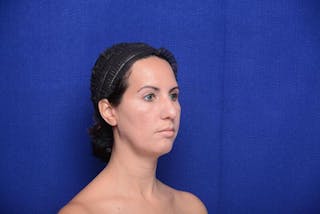 Rhinoplasty Before & After Gallery - Patient 174888 - Image 6