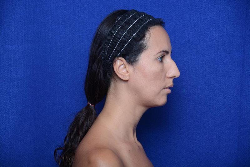 Rhinoplasty Before & After Gallery - Patient 174888 - Image 7