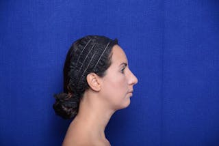 Rhinoplasty Before & After Gallery - Patient 174888 - Image 8