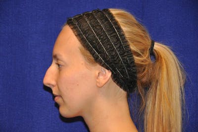 Rhinoplasty Before & After Gallery - Patient 198172 - Image 1