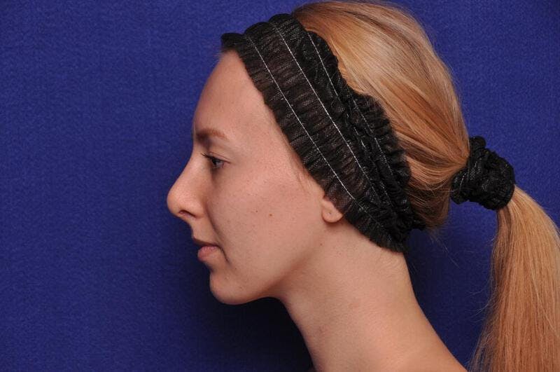 Rhinoplasty Before & After Gallery - Patient 198172 - Image 2
