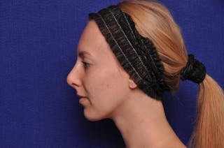 Rhinoplasty Before & After Gallery - Patient 198172 - Image 2