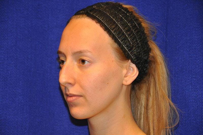 Rhinoplasty Before & After Gallery - Patient 198172 - Image 3